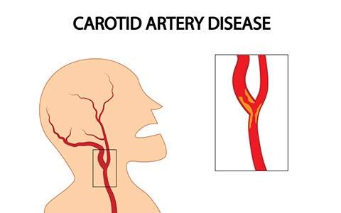 Risk of Carotid Stroke after Chiropractic Care: A Population-Based Case-Crossover Study